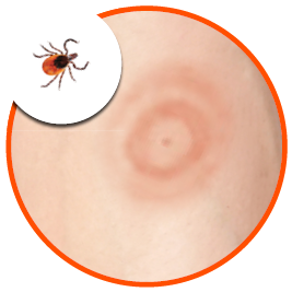 an example of tick bites bulsseye shape.